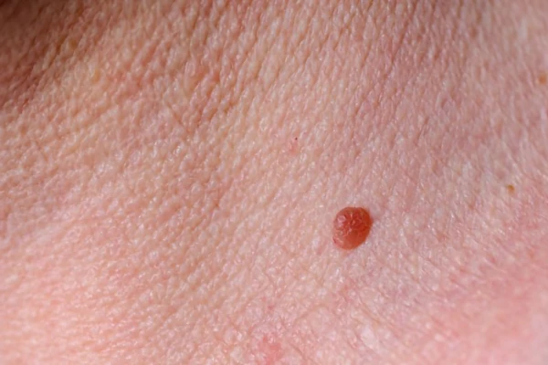 Image for article titled New Tele-Dermatology Pilot